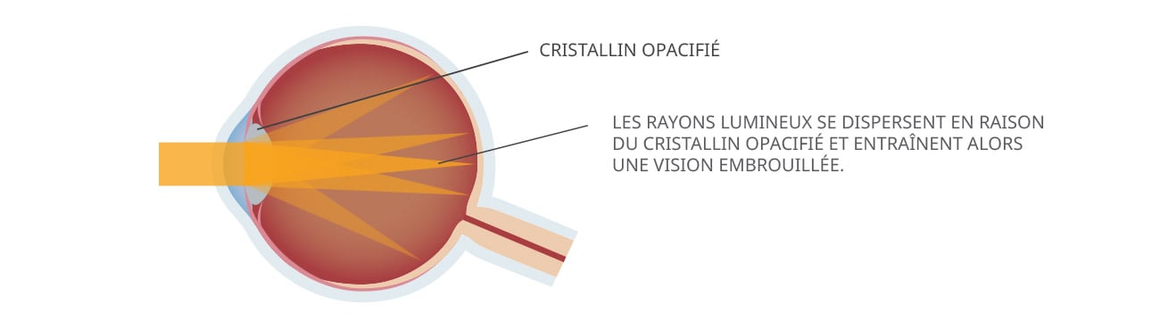 Cataract Graphic FR